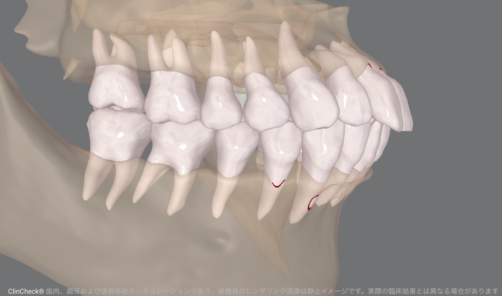70歳で矯正治療を開始AIとマウスピース矯正が後押しする「期限を決めた歯科治療」という選択